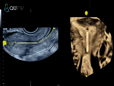 IUD 1