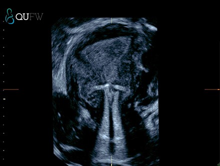 IUD 2