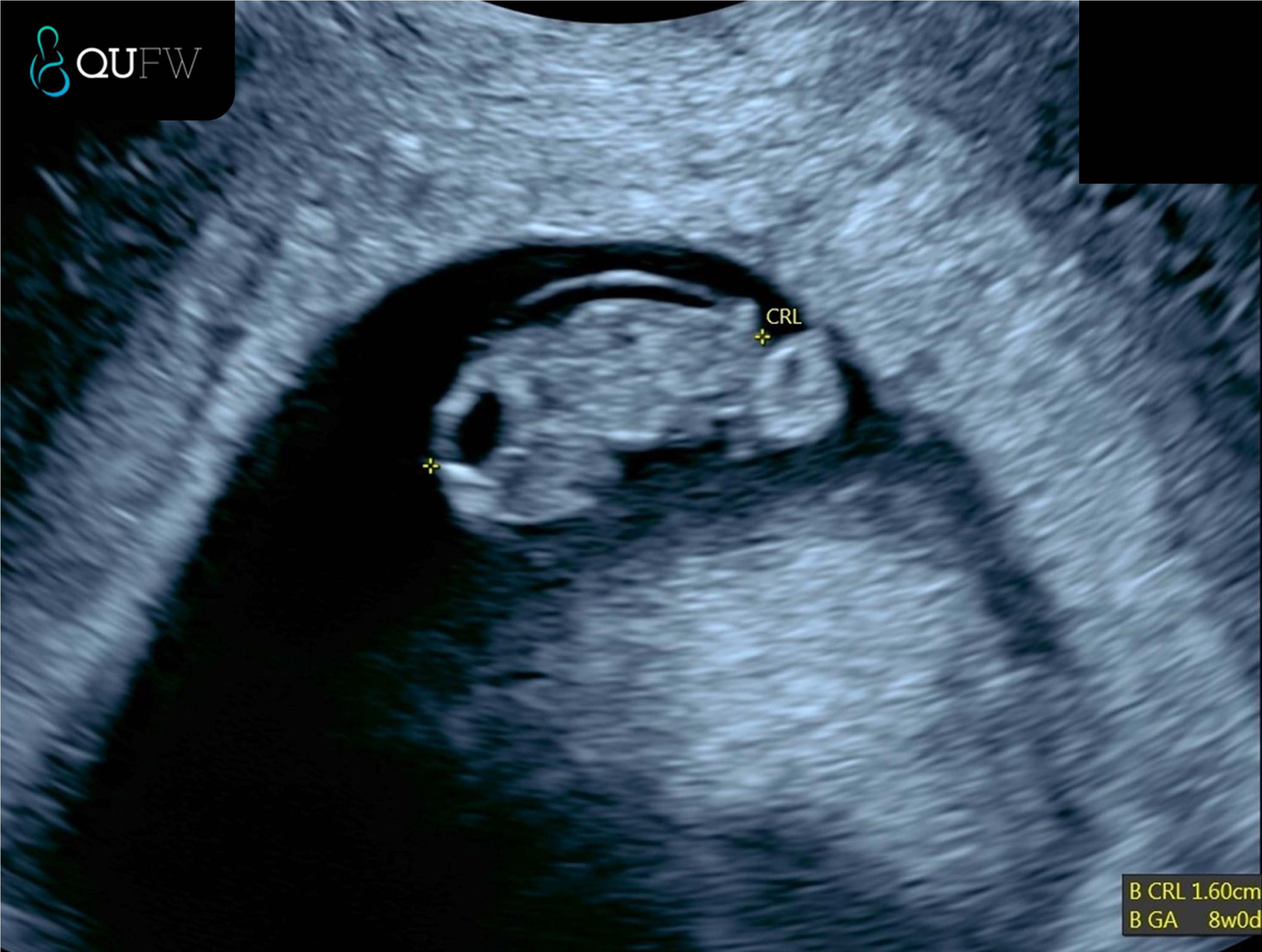 Early Pregnancy Assessment QUFW Early Pregnancy Assessment QUFW
