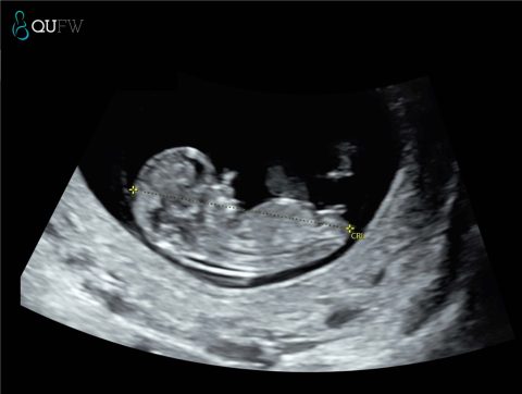 Viability/dating scans vs. early anatomy scans vs. first trimester ...