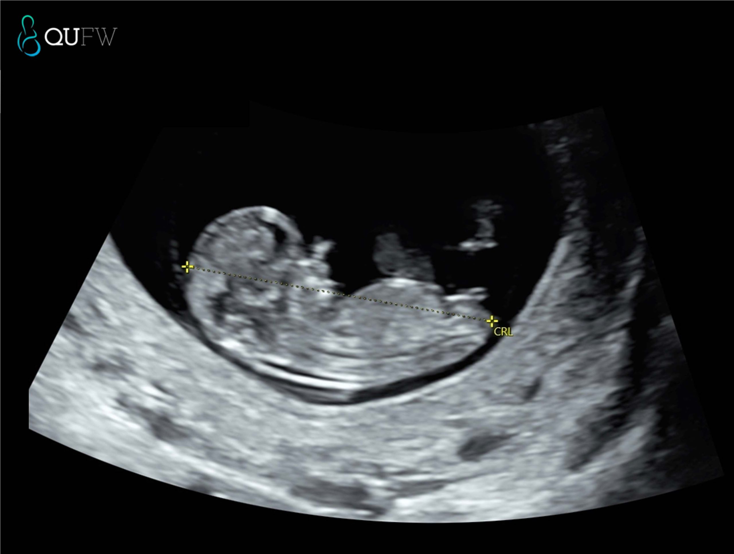 Dating scan prior to NIPT