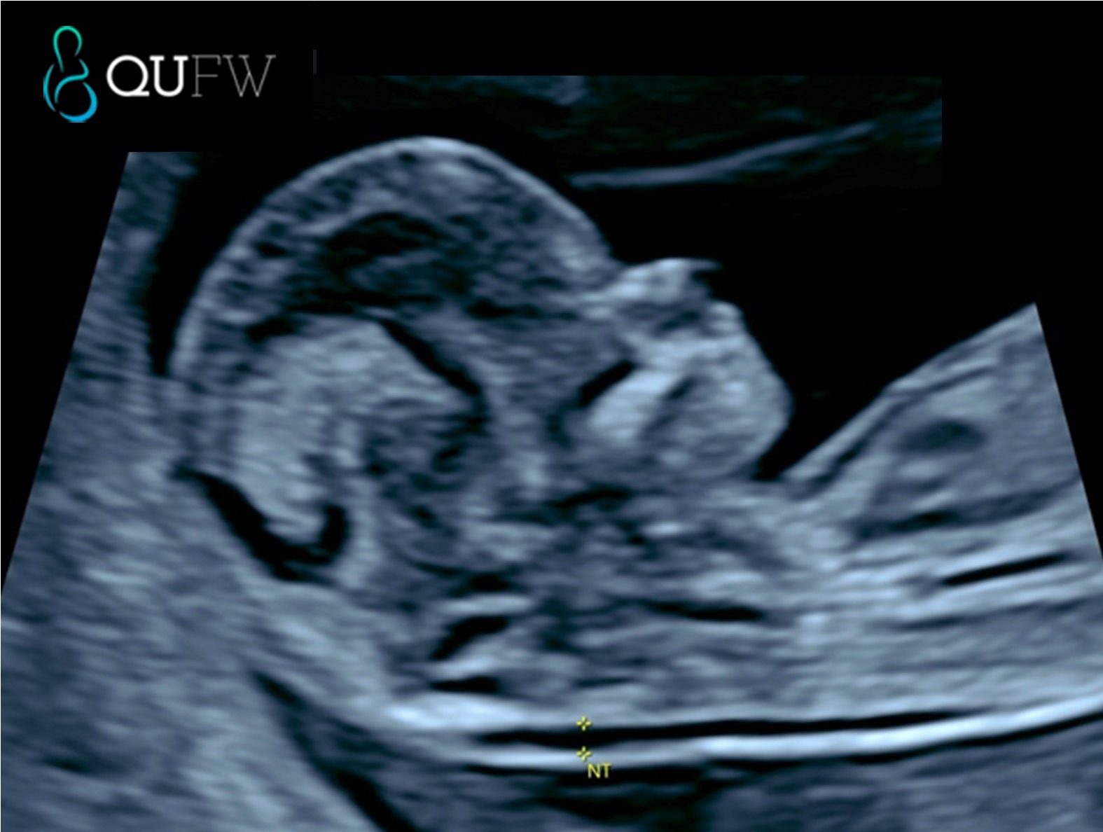 Nuchal translucency assessment